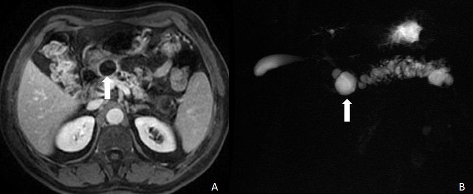 Fig. 5 - Imagens axial (A) e coronal (B) ponderadas em T2 sem saturação de gordura, imagem axial ponderada em T1 com saturação de gordura após adminstração de gadolíneo endovenoso na fase tardia (dez