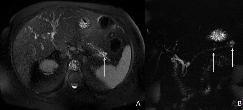 visualizados nas imagens C (coronal T1 pós injecção de gadolíneo) e D (imagem MIP da CPRM). Fig. 14 - Imagem axial ponderada em T2 com saturação de gordura (A) e imagem CPRM (B).