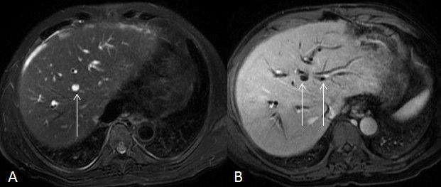 Fig. 16 - Imagem axial ponderada em T2 com saturação de gordura (A) e imagem axial ponderada em T1 com saturação de gordura após adminstração de gadolíneo endovenoso na fase venosa hepática (B).