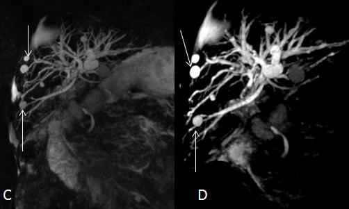 As imagens C e D correspondem a imagens MIP de CPRM de outra examinada com Doença de Caroli. Apercebemo-nos que as lesões nodulares quísticas (setas) apresentam continuidade com os ductos biliares.