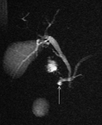 Os defeitos de pseudo-preenchimento podem ser provocados por cálculos, neoplasias, bolhas de ar ou sangue, sendo algumas das causas menos frequentes os artefactos de susceptibilidade Fig.