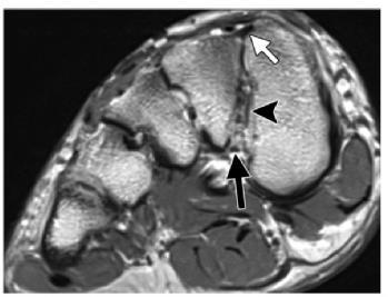 Imagem 2A Imagem 2B Legenda: Anatomia normal do complexo ligamentar de Lisfranc.