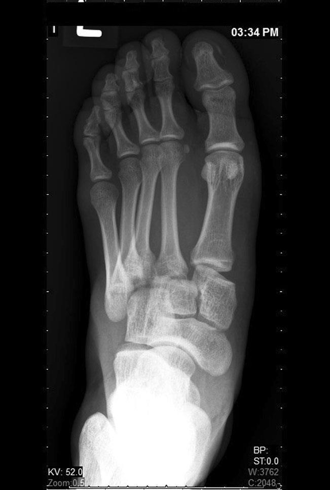 Imagem 4 Legenda: Radiografia AP do pé que mostra uma fractura-luxação de Lisfranc do tipo A, de acordo com a classificação de Myerson.