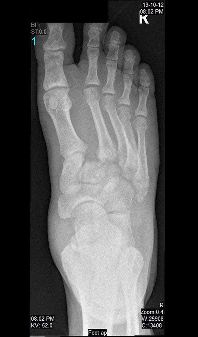 Imagem 5 Legenda: Radiografia AP do pé que mostra uma fractura-luxação de Lisfranc do tipo B2, de acordo com a classificação de Myerson.