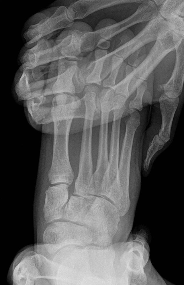 Imagem 9 Legenda: Radiografia do pé com aplicação de stress (abdução forçada do antepé) ao complexo articular tarsometatarso, que torna evidente a presença de instabilidade, traduzida