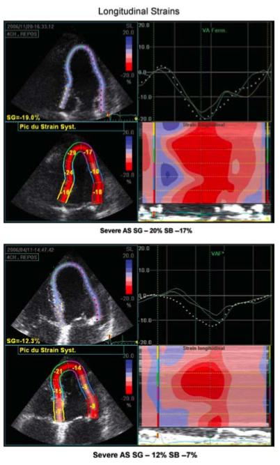 Strain Longitudinal Tolerância ao esforço