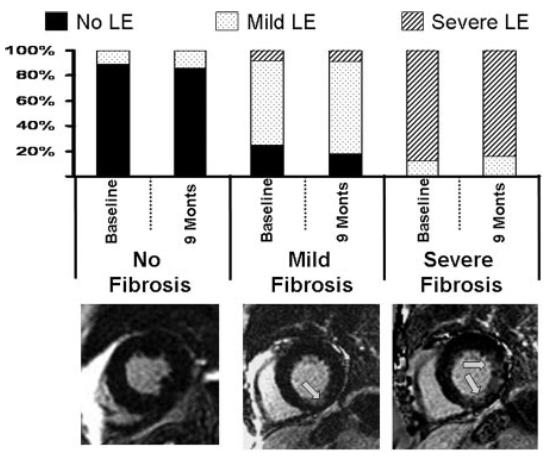 RM Cardíaca Fibrose Miocárdica