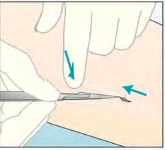 Nesse caso, será necessário um corte pequeno na pele antes que o implante possa ser retirado.