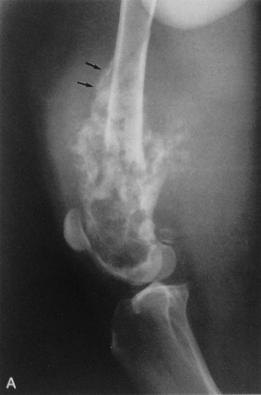 7 No osteossarcoma é radiograficamente evidente a proliferação óssea periosteal em cerca de 95% das lesões, chamada de explosão solar, ou a destruição do osso adjacente (BURK; FEENEY, 2003; ANDRADE,