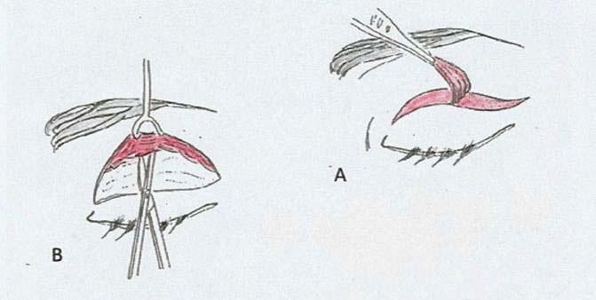 equilibrar a função dos músculos da expressão facial. São utilizados dois acessos: um acesso bilateral de 2cm e outro logo acima do contorno capilar lateral da sobrancelha.