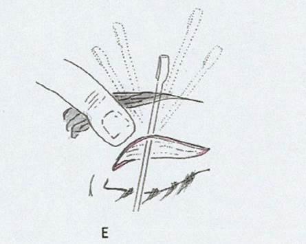 Nos casos onde as bolsas na pálpebra superior são extremamente aparentes, o septo orbital também pode ser plicado com sutura absorvível 6-0 para reduzir a herniação da gordura.