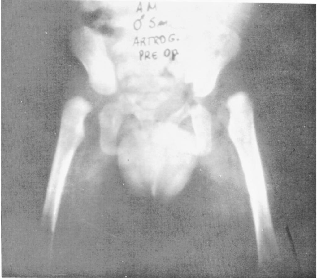 L... ROCHA,.H. GRI, L.A.. CUNHA,. ORLIN & A.C. PAULTO ig. 7 Caso 24 - pré-operatório. ig. 9 Caso 24-18 meses de pós-operatório. Resultado satisfatório. da redução foi de três, sete e oito meses.