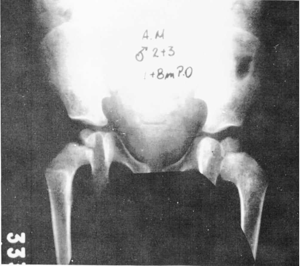 A subloxação foi observada com oito semanas de pósoperatório, necessitando na evolução de procedimentos secundários para a manutenção da redução e correção da displasia acetabular residual.