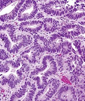 Gastric epithelial dysplasia In high-grade dysplasia, the architectural changes become pronounced, seen as a loss of intervening stroma and back to back orientation of the dysplastic glands The