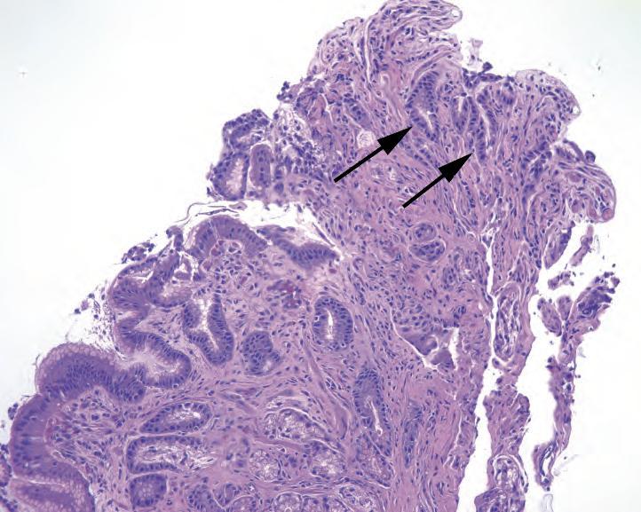 Reparative changes next to an ulcer Arrows- collection of poorly formed glands with an infiltrative look and minimal cytoplasm, giving the appearance of a high nuclear/cytoplasmic ratio.