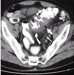 flatulência ou hábito irregular também associado à Síndrome do Colón Irritável. Até 25% destes pacientes evoluem com diverticulite, e até 15% com sangramento diverticular.