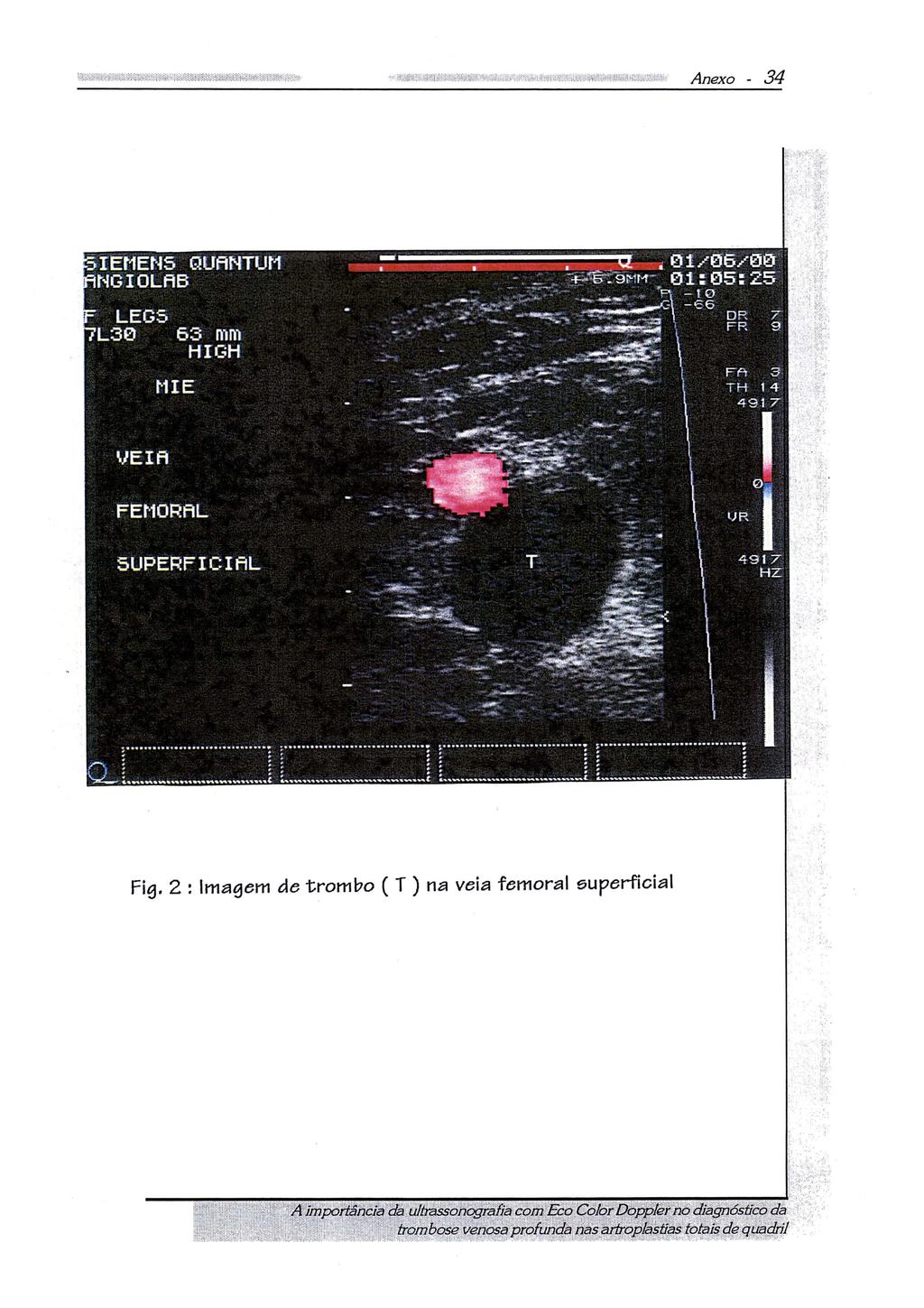 Fig. 2 : Imagem de trombo ( T ) na