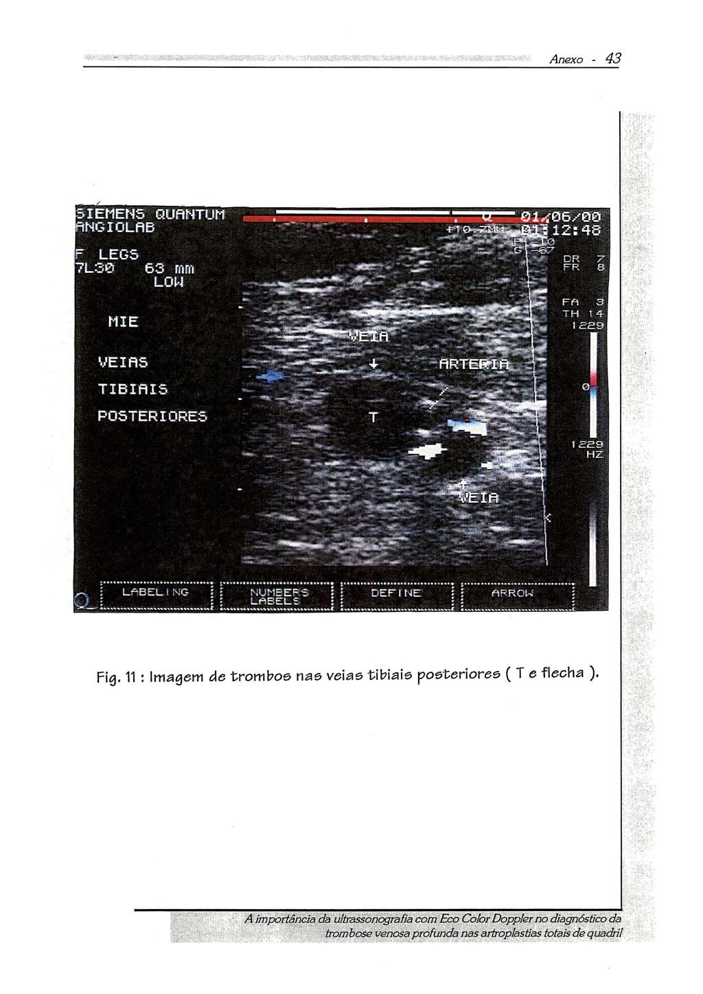 figo 11 : Imagem de trombos nas