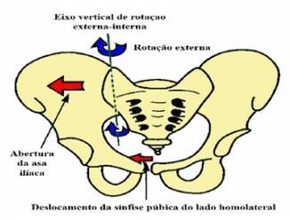 Há deslocamento da sínfise púbica homolateral do lado contralateral e abertura da parte posterior da articulação que produz tensão ligamentar posterior (RICARD,