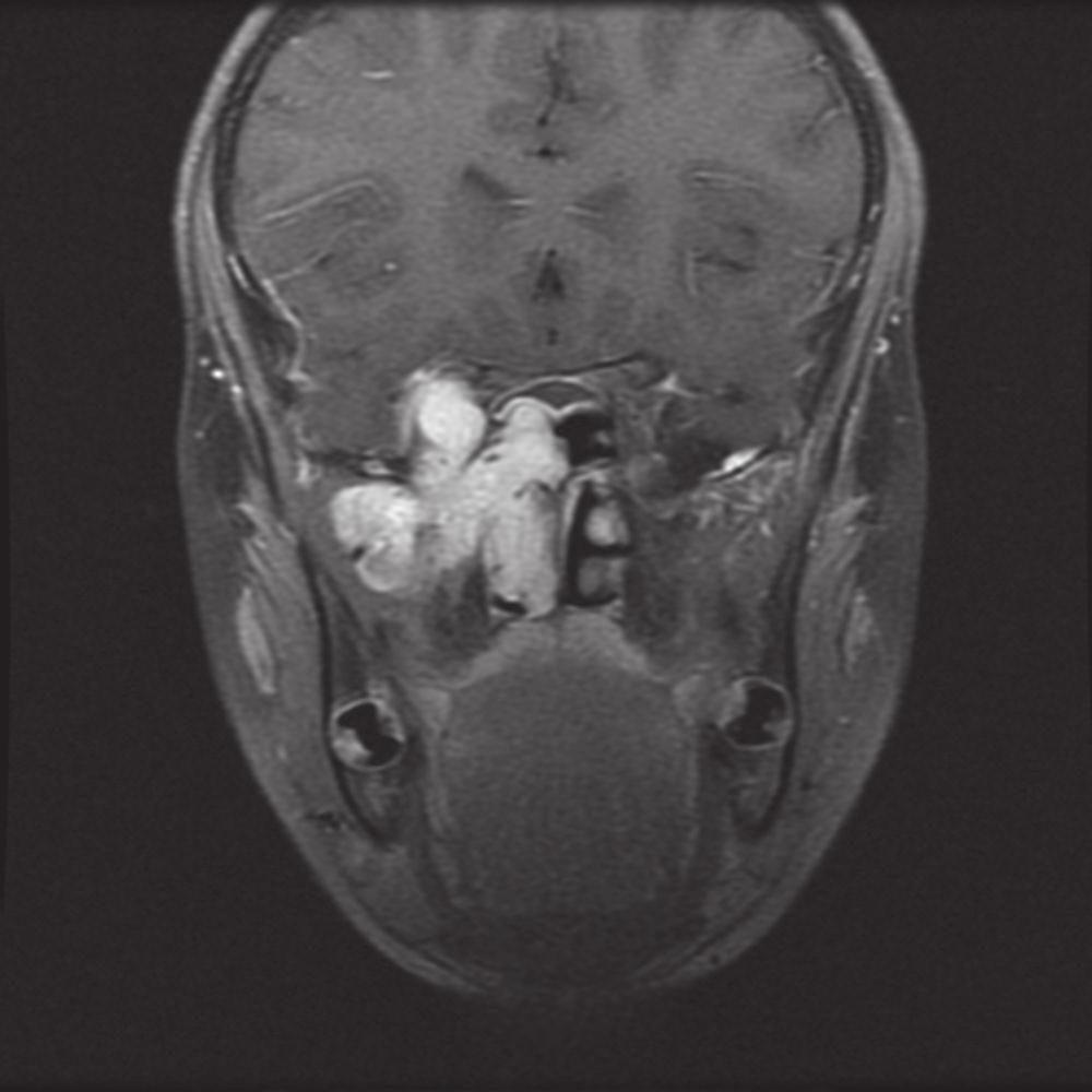 Endoscopic and endoscopic-assisted treatment of juvenile nasopharyngeal angiofibroma 123 Figura 3 Ressonância magnética (corte coronal) do mesmo paciente das Figs.1 e 2.