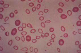 HEMATOLOGIA LABORATORIAL - ERITRÓCITOS A talassemia maior por lesão no gene beta afeta os dois genes beta (normal: β/β; talassemia maior: β/β ou β / -; ou - / -).