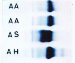 Por essa razão a talassemia beta maior tem expressões clínicas variáveis entre grave a muito grave, com anemia intensa (Hb: 6g/dL) a muito intensa (Hb: 4g/dL).