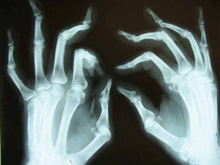 19 mãos e 48% de ambas articulações (22). Sinais radiológicos característicos auxiliam na compreensão dos fenômenos funcionais e queixas associadas (Figura 2). Figura 2.