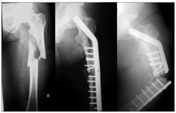 306 INTRODUÇÃO As fraturas da extremidade proximal do fémur (FEPF) são de entre todas as fraturas associadas à osteoporose as que maior impacto têm do ponto de vista clínico.
