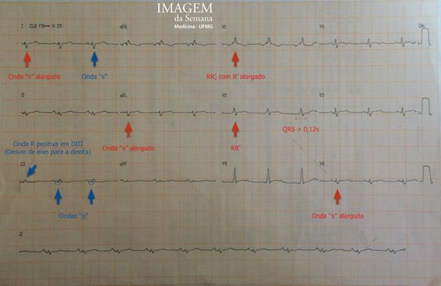Imagem 2: Eletrocardiograma de 12 derivações. Ritmo sinusal, FC de 75 bpm. Onda p de eixo, duração e morfologia normais. Intervalo PR inferior a 0,20s. Complexo QRS de duração aumentada (0,12s).