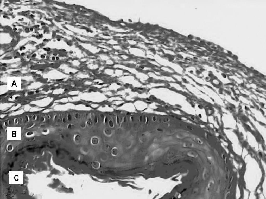 Imagem digitalizada de lâmina, com corte transversal de colesteatoma, corada em Hematoxilina-Eosina; apresentando suas partes constituintes: A. Perimatriz; B. Matriz; C. Conteúdo Cístico.