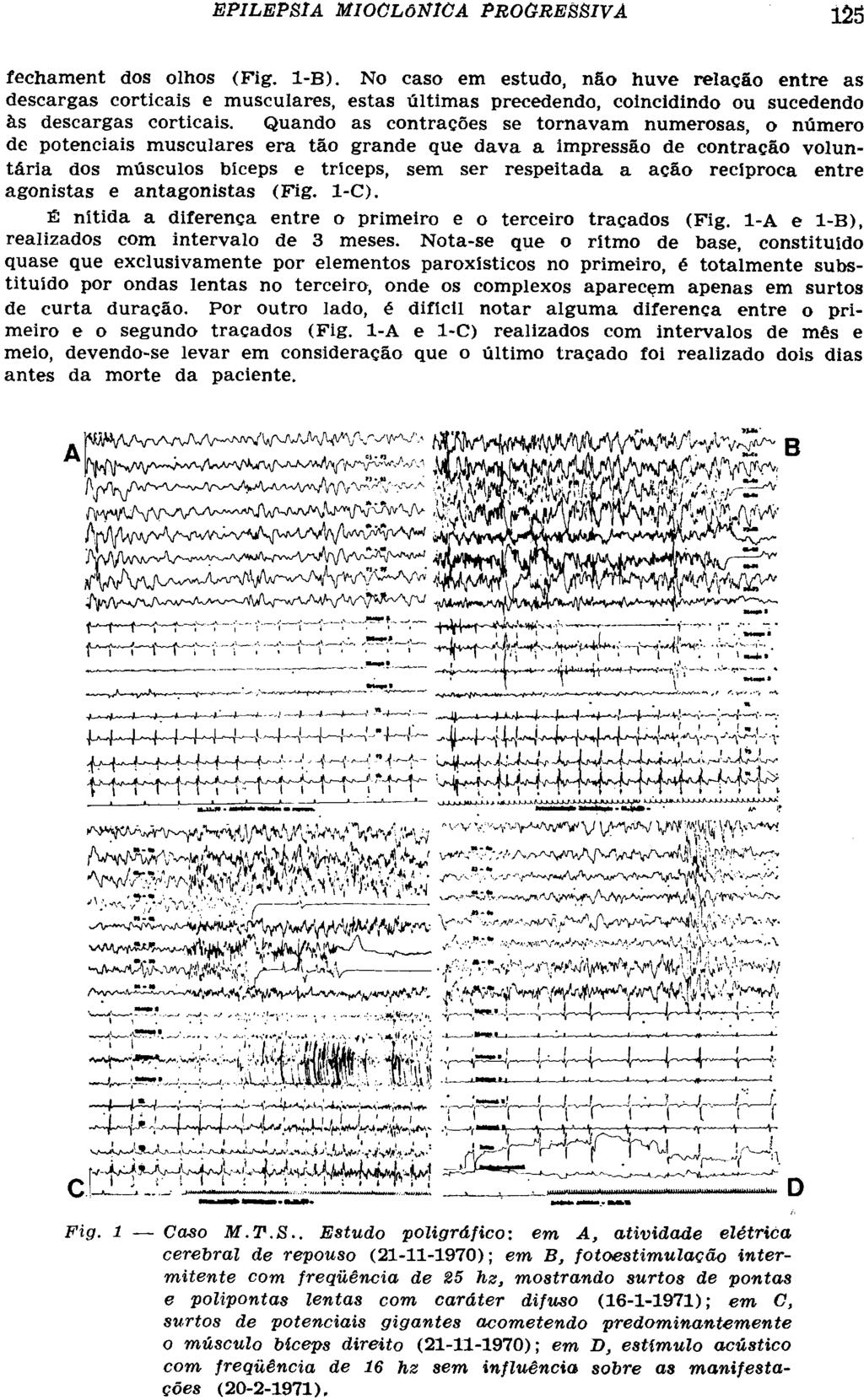 fechament dos olhos (Fig. 1-B). No caso em estudo, não huve relação entre as descargas corticais e musculares, estas últimas precedendo, coincidindo ou sucedendo às descargas corticais.