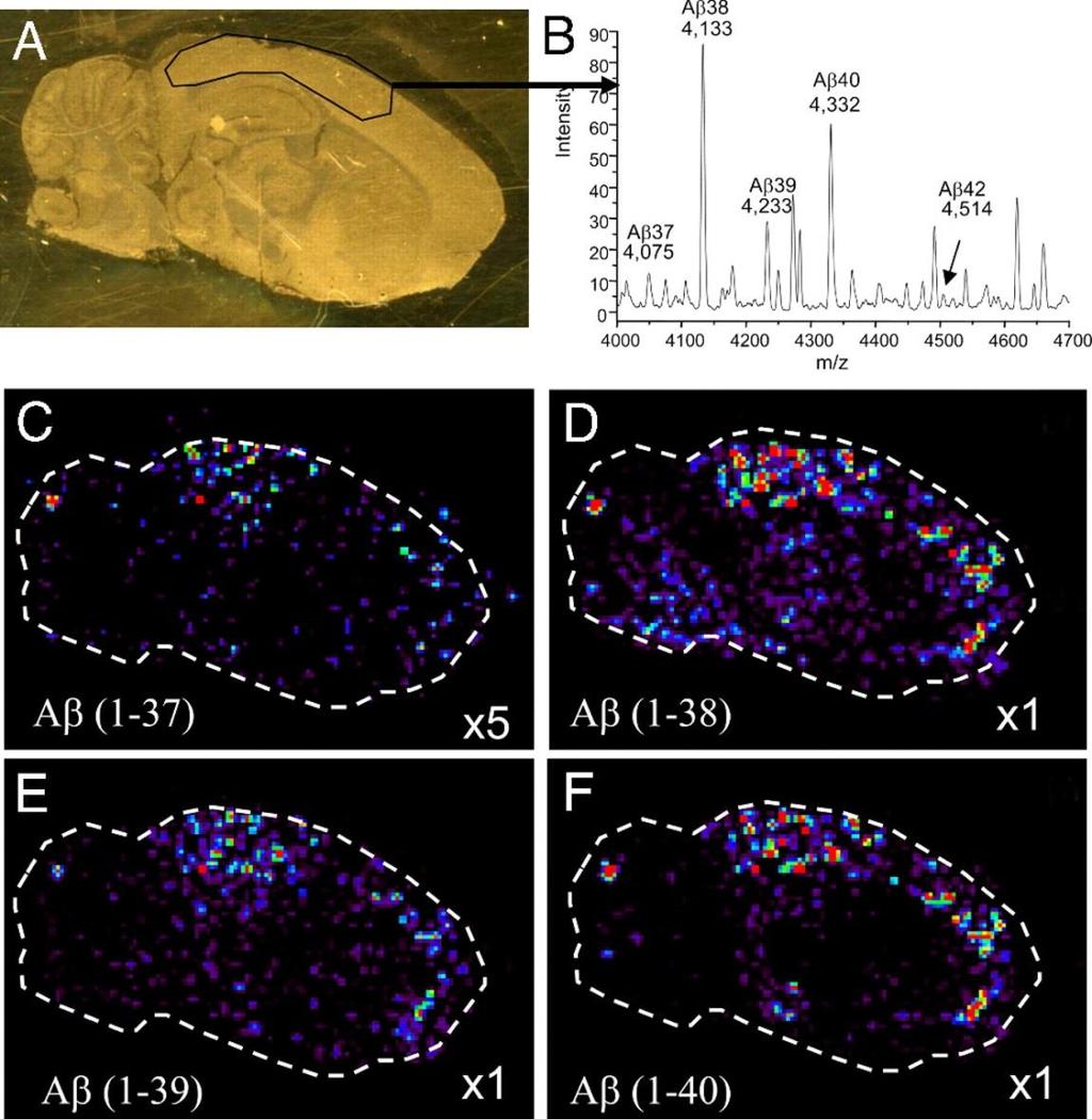 IMS allows for distinction of different molecular species of β-amyloid plaques in an Alzheimer's