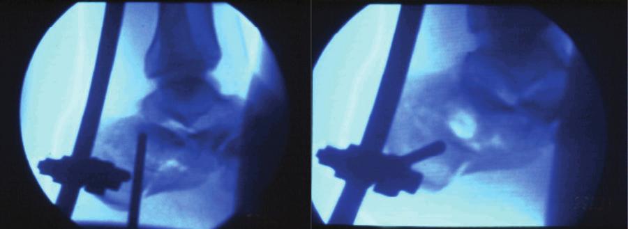 B) A distração corrige o varo e alinha a parede medial (fragmentos sustentacular e tuberositário). C) As partes moles acompanham o alinhamento. Figura 3.