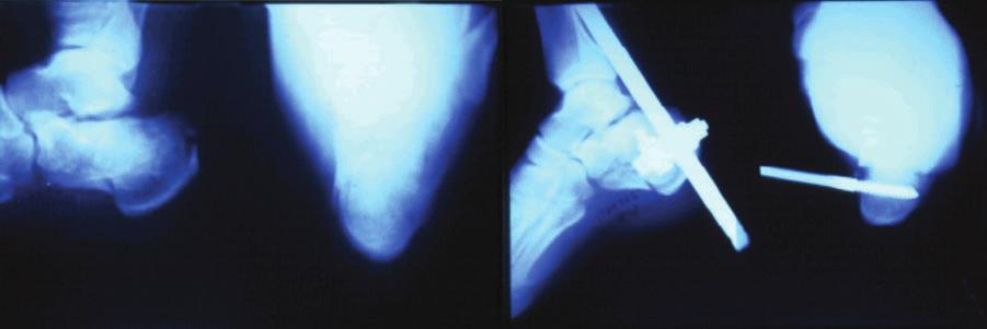 Esta primeira etapa deve ser controlada com intensificador de imagem nos planos sagital e axial (Figura 3). Obtida a redução da parede medial, passa-se à segunda etapa do procedimento.