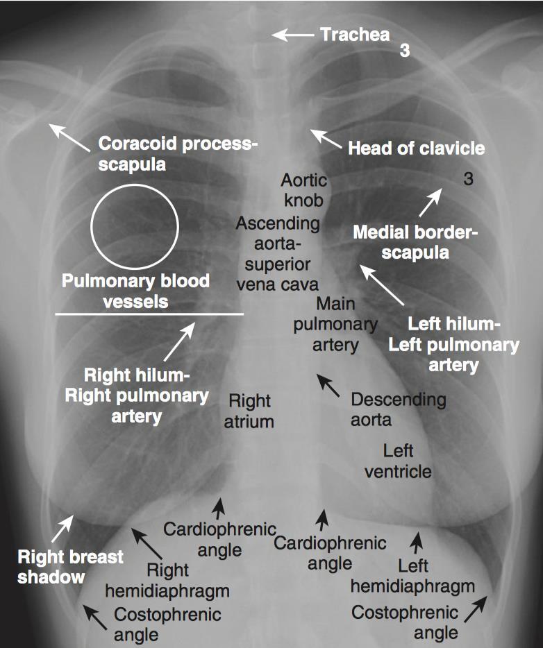 Radiografia do Tórax Anatomia Torácica Vasos imagens