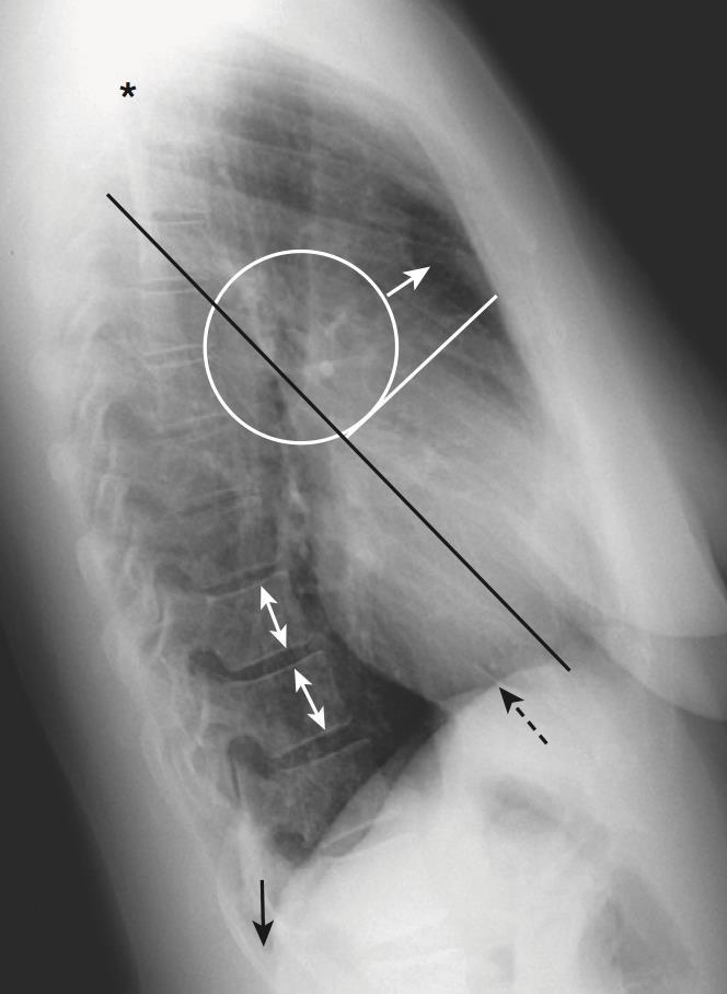 Radiografia de Perfil Anatomia Torácica Espaço Anterior (Retroesternal); Espaço Posterior: Sinal da
