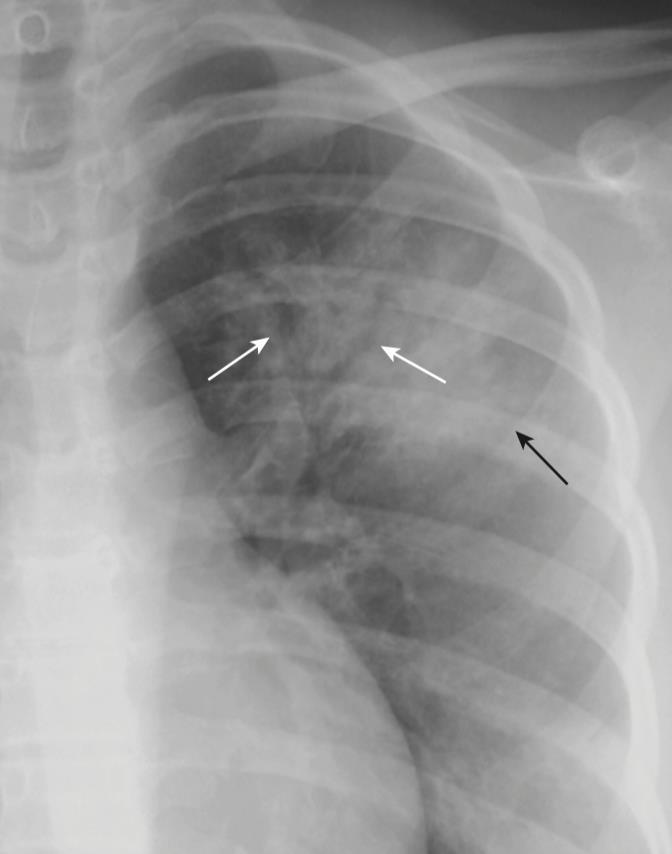 Maioria com padrão de doença alveolar; Quando existe exsudato