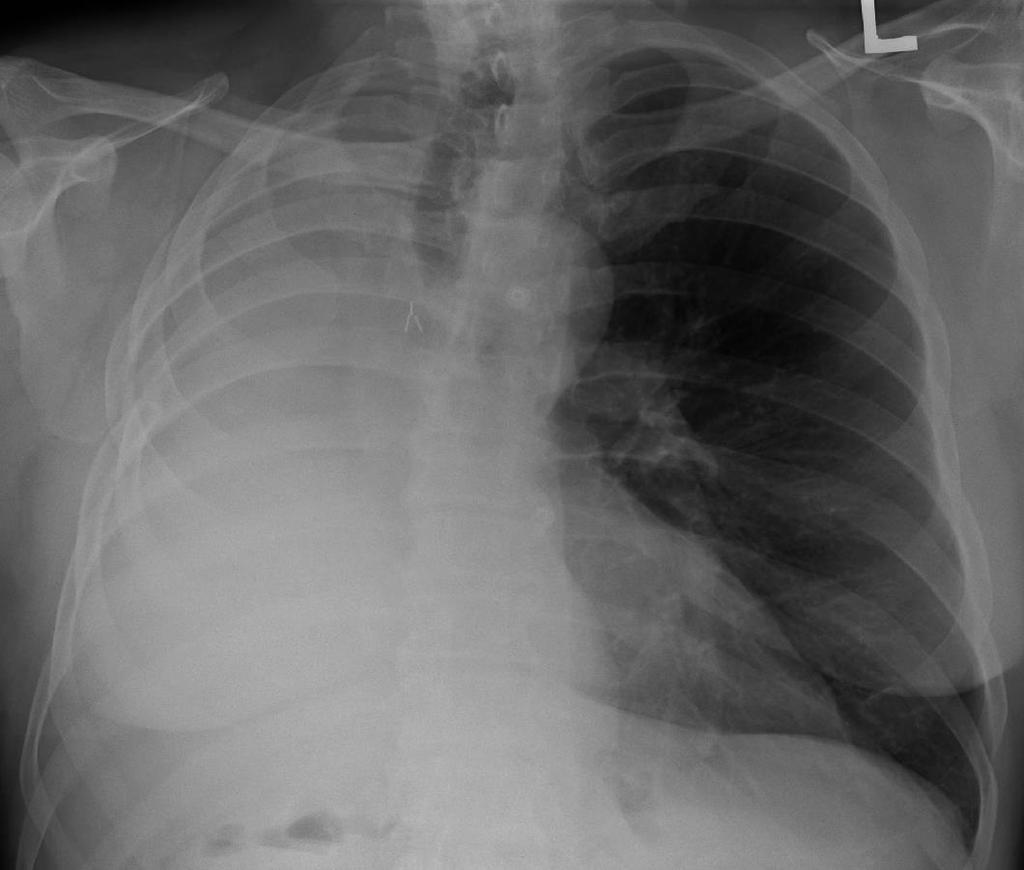 Radiografia do Tórax Opacidade Pulmonar Opacidade homogénea da totalidade ou quase a totalidade de um campo pulmonar; Dados a ter em
