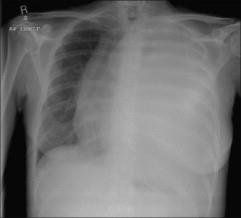 Radiografia do Tórax Opacidade Pulmonar Caso