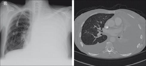 Radiografia do Tórax Opacidade