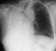 Radiografia do Tórax Opacidade Pulmonar Caso C Colapso pulmonar sem