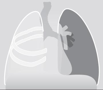 Radiografia do Tórax Opacidade Pulmonar Caso D Pneumonectomia Alterações da