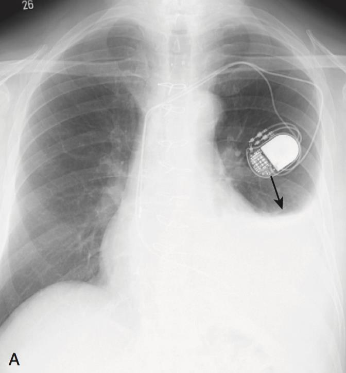 Radiografia do Tórax Derrame Pleural - Lateralidade Derrame bilateral: Insuficiência Cardíaca Congestiva; Lúpus -