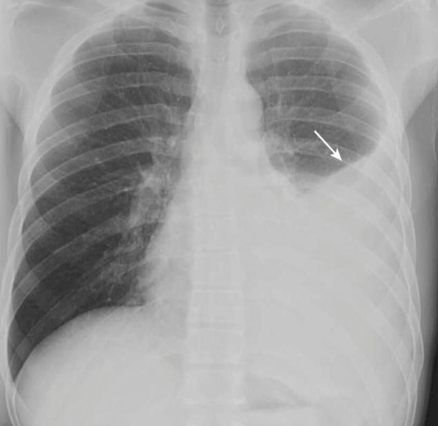 Radiografia do Tórax Derrame Pleural - Lateralidade Derrame direito: Patologia abdominal (Hepática ou anexial) Síndrome de Meigs; Artrite