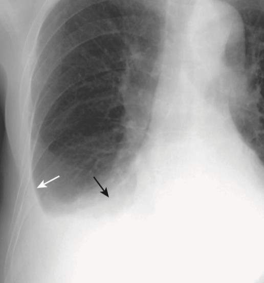 Radiografia do Tórax Derrame Pleural Tradução