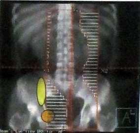 Long-term Results of Adjuvant Irradiation for Stage I Testicular Seminoma H. Lee, J. Chang, J. Kim, S.