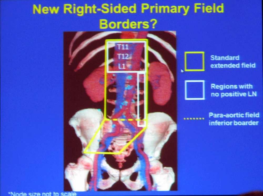 Mapping Patterns of Nodal Metastases in Seminoma: Rethinking the