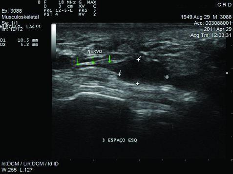 fechados), no exame físico, na dor à dígito pressão no espaço intermetatársico comprometido (Figura 1), na radiografia do pé, para descartar outras patologias, e no estudo ultrassonográfico do antepé