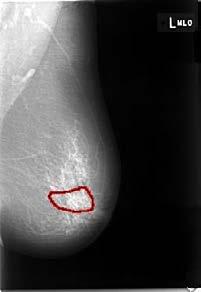 projeções: Médio Lateral Oblíqua (MLO) e uma Crânio-Caudal (CC). Na Figura 2, podemos ver dois exemplos de mamografia. a) MLO esquerdo b) MLO direito c) CC esquerda d) CC direito Figura 2.