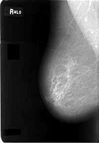 a) e b) Mamografias com incidência Médio- Lateral Oblíquo em ambas as mamas, sendo que em (b) mostra delimitado em vermelho uma massa maligna [Heath et al.